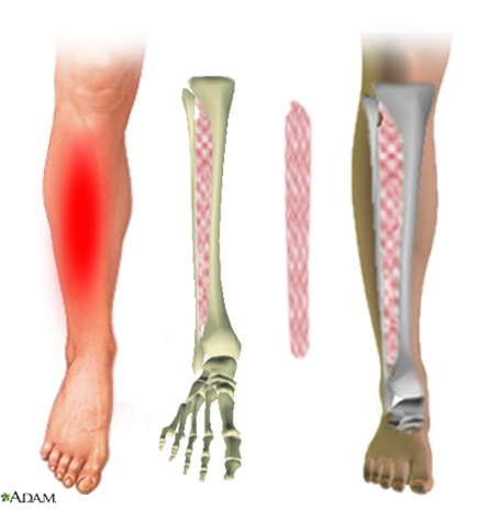  Interosseous Membrane. 